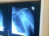 shoulderxray.jpg