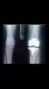 KneeReplacement.jpg