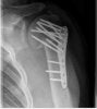 left shoulder.jpg