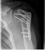 Left Shoulder.JPG