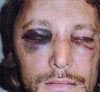 Black-eye2.jpg