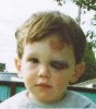 Black_eye1.jpg